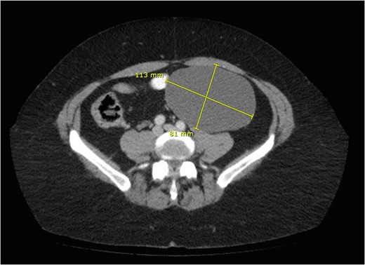 CT scan showing cyst.