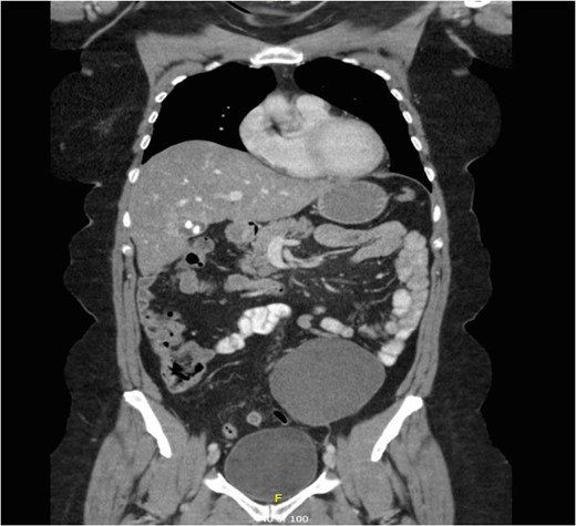 Coronal plane of CT.
