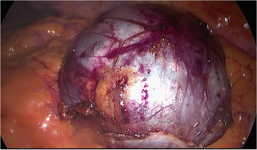 Image of sigmoid mesenteric cyst.