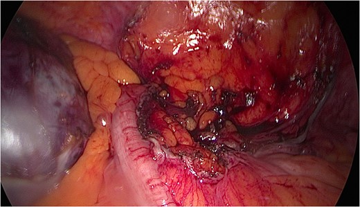 Sigmoid mesentery with cyst excised.