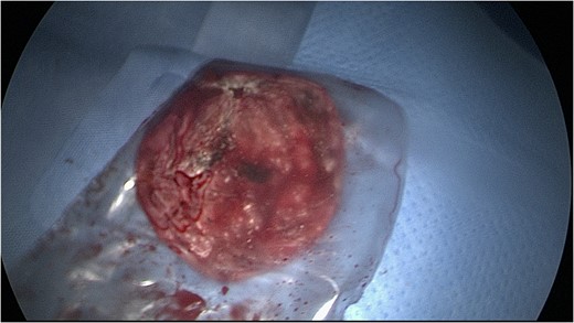 Cyst drained and removed using an endocatch.