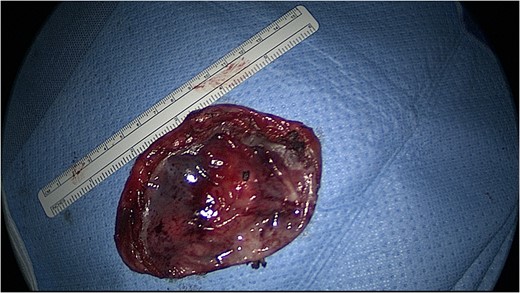 Cyst drained measuring about 11 cm.