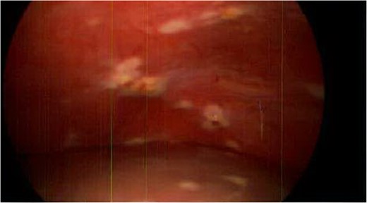 Liver and peritoneum with metastatic implants.
