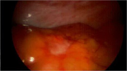 Omental metastatic lesion.