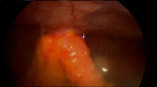 Spigelian hernia. Omental metastatic lesion protruding through the semilunar line.