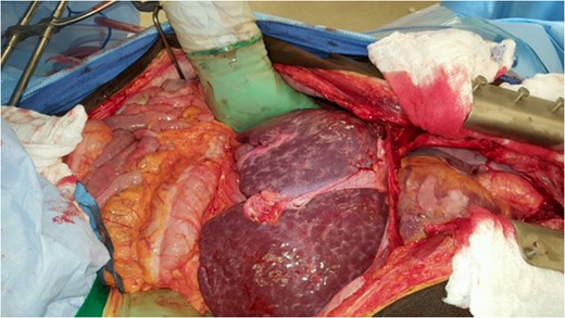 Gross appearance of donor liver with granulomatous surface.
