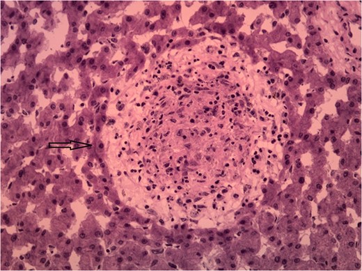 Histological slide showing granuloma.