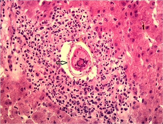 Granuloma with ova.