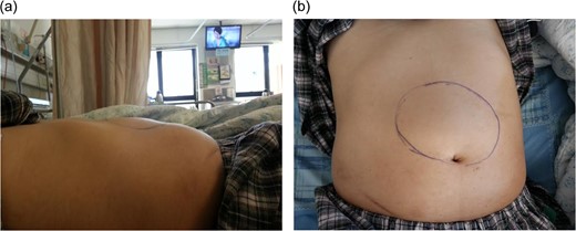 Physical examination showed large epigastric mass (a and b).