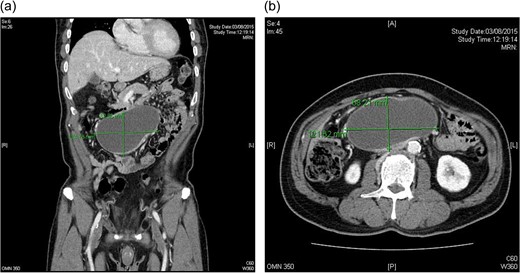 CT scan: 12.4 × 7.1 × 8.9 cm oval cystic lesion over central lower abdomen abutting loop of small bowel with compression on IVC, could represent a mesenteric cyst. No adrenal lesion (a and b).