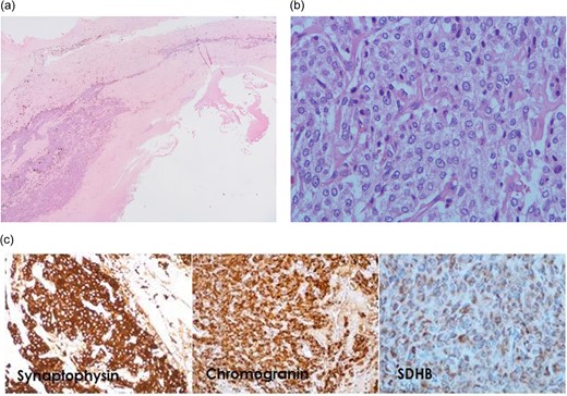 Microscopic examination. (a) The cyst wall shows mostly hypocellular fibrous tissue with tumor cells recognized in the relatively thicker portion (H&E ×20). (b) The tumor cells form nests surrounded by capillaries. They possess ample amount of amphophilic granular cytoplasm and roundish to slightly elongated nuclei with small nucleoli (H&E ×400). (c) The tumor cells are stained positive for neuroendocrine markers synaptophysin and chromogranin (×200). They are also positive for SDHB (×400).