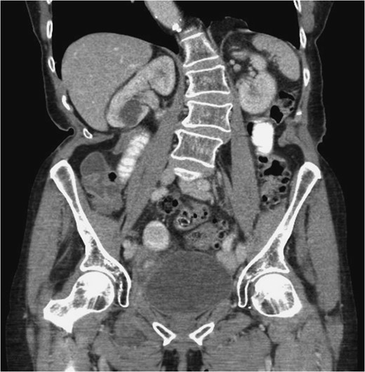 Coronal plane. The right obturator hernia is demonstrated. It contains small bowel loop. Proximal small bowel is mildly dilated. Right obturator hernia with features of incomplete small bowel obstruction.