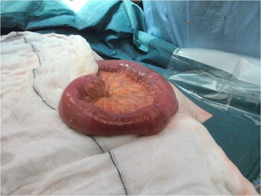 Segment of incarcerated bowel after release from hernia defect.