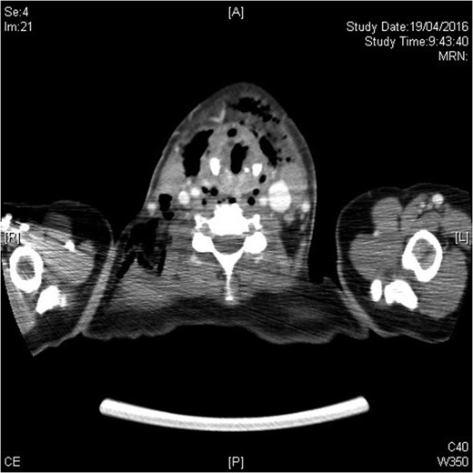 Extensive involvement to all deep neck spaces.