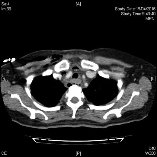 Infection extending down to superior mediastinum and chest wall.
