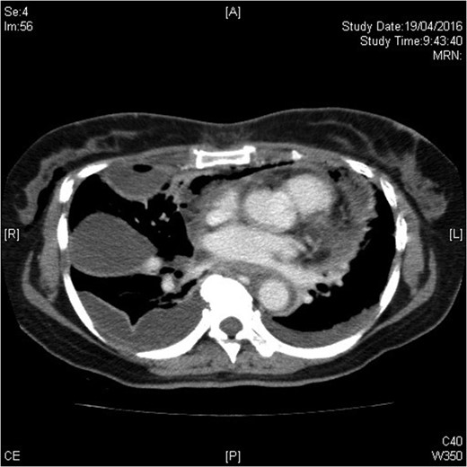 Loculated right empyema thoracis.