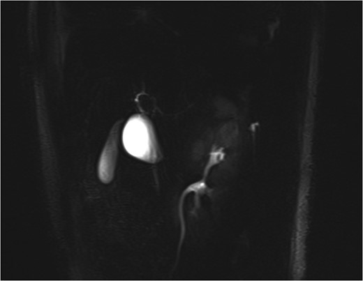 MRCP showing the cystic dilatation along the lateral wall of the bile duct mimicking a Type II choledochal cyst with GB seen separately.