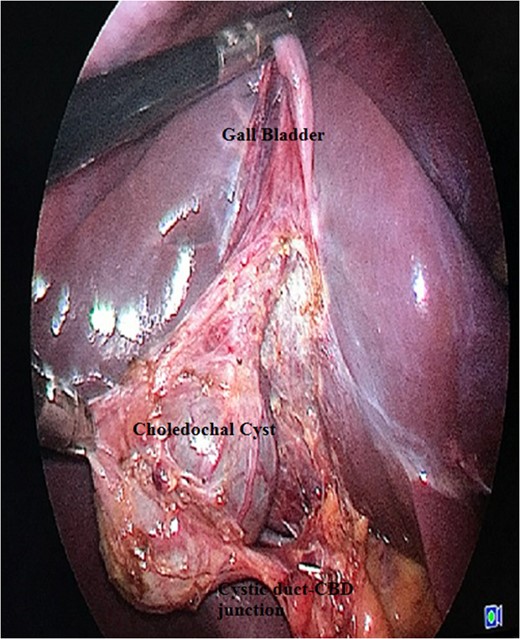 Laparoscopic view showing Calot's triangle dissected with choledochal cyst seen separately from the rest of the GB.