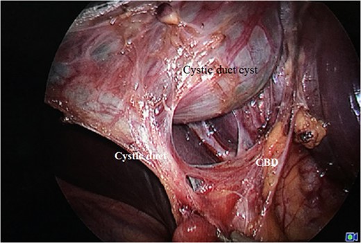 Cyst seen along with the cystic duct stalk and the arterial twig supplying the cystic duct.