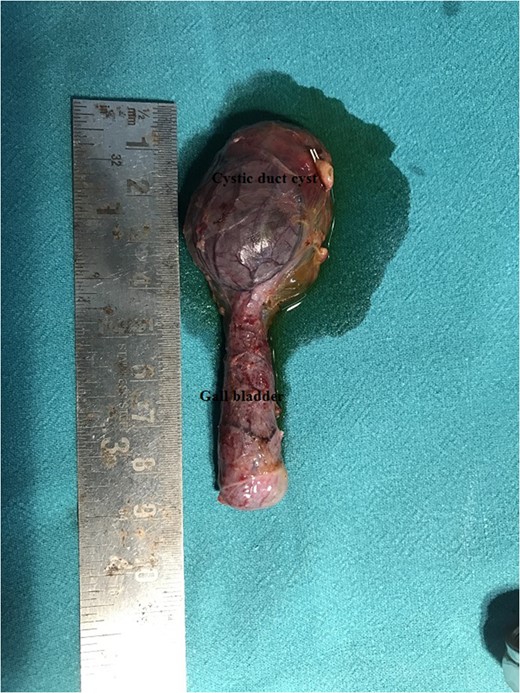 Gross specimen showing the GB along with the cyst arising from the cystic duct (specimen filled with saline showing communication between the cyst and GB).