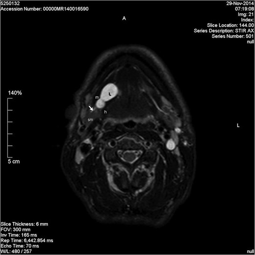 Axial STIR image showing a lobulated homogenous hyperintense lesion in the right floor of mouth. L, lesion; m, mylohyoid muscle; sm, submandibular gland; h, hyoglossus; short arrow, Wharton's duct.