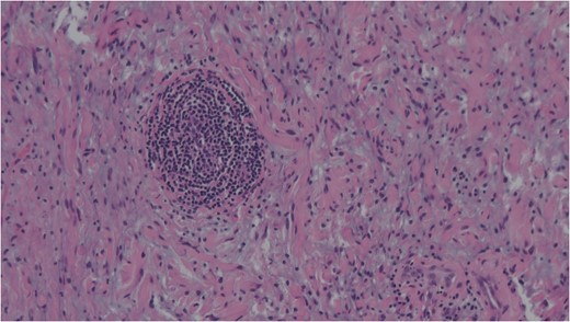 Spindle cells set in a myxoid stroma characteristic of schwannoma. Haemotoxylin and eosin (H&E).