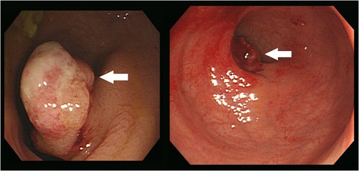 Colonoscopy revealed an ~2.5 cm-sized pedunculated lesion with surface ulceration at 10 cm from the anal verge (arrows).