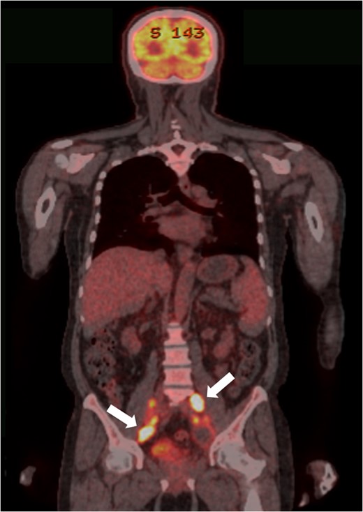 PET-CT findings. Multiple metastases to LNs along the inferior mesenteric and superior rectal arteries (arrows) are noted.