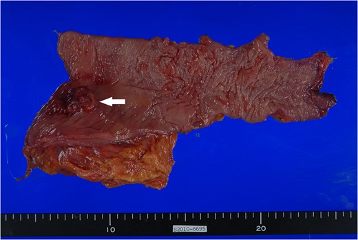 Surgical specimen. Approximately 3.0 Ă— 2.5 cm polypoid mass with ulceration (arrow) is noted at 1.5 cm from the distal margin.
