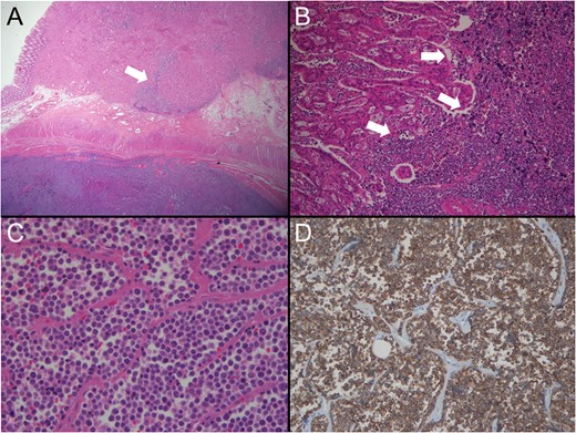 Pathological findings. (A) Lower power view shows two different tumours (low dark and upper light) coexisting with collision area (arrow) (H&E ×10). (B) Collision area reveals the border (arrows) between the moderately differentiated adenocarcinoma (left) and the poorly differentiaed SCC (right) (H&E, ×200). (C) The tumour consists of discohesive, small and round cells with scanty cytoplasm. No gland formation is seen (H&E, ×400). (D) The tumour cells are diffusely positive for synaptophsin immunostaining (×100).