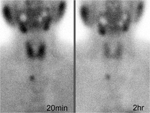 Technetium-99-sestamibi (99mTc-MIBI) imaging showing focal uptake during early (left) and delayed (right) phases in the mediastinum.