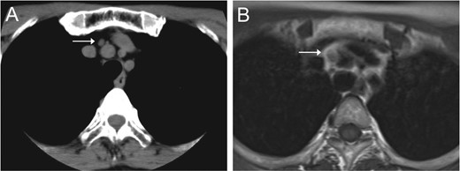 Chest CT (A) and MRI (B) revealed a mediastinal nodule adjoining the BCA.