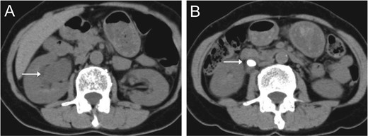 Abdominal CT indicated right hydronephrosis (A) and ureteral stones (B).