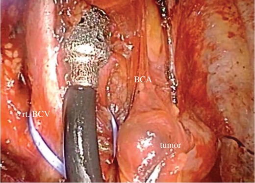 Thoracoscopic view of the mediastinal tumor.