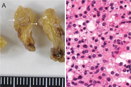 Macroscopic (A) and microscopic (B) views of the nodule confirmed the diagnosis of ectopic parathyroid adenoma.