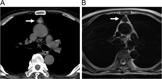 Enhanced CT (A) and MRI (B) of the chest revealed an anterior mediastinal tumor.