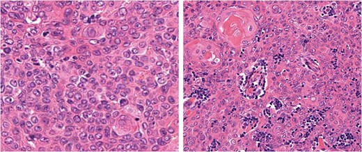 Histological findings of the tumor. Hematoxylin and eosin staining.