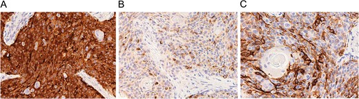 Immunohistochemical findings of the tumor for synaptophysin (A), chromogranin (B) and CD56 (C).