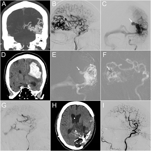 (A) CT angiography (coronal view) revealed a 4-cm AVM at the left temporo-occipital region. (B and C) Lateral projection of early (B) and frontal projection of late (C) arterial phase of left internal carotid angiograms demonstrated a high-flow AVM and a co-existing venous aneurysm on the draining vein (arrow), which ruptured 1 month after this angiographic study. (D) Emergency CT performed after the patient lost consciousness revealed a massive parenchymal hemorrhage at the left parieto-temporal region. (E and F) Microcatheter was advanced into the ruptured venous aneurysm, where detachable coils were deployed (arrow). (G) Following targeted embolization, the size and flow of the residual AVM were significantly reduced. (H) Follow-up CT 3 months later showed total resolution of the brain edema. (I) The follow-up internal carotid angiogram also demonstrated complete angiographic regression of the residual AVM.