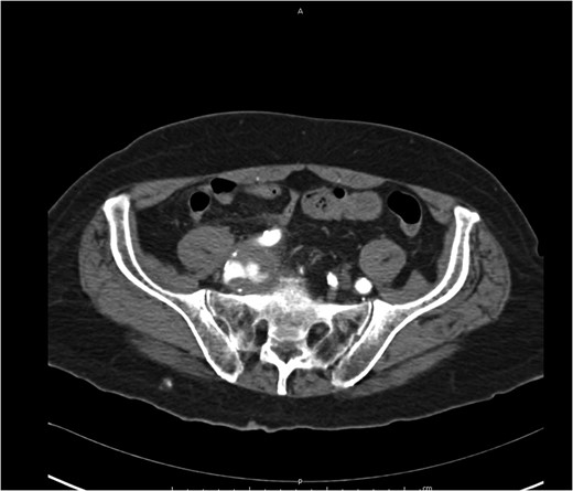 Axial view iliac aneurysm with partially thrombose contact rectosigmoid colon and contrast leak.