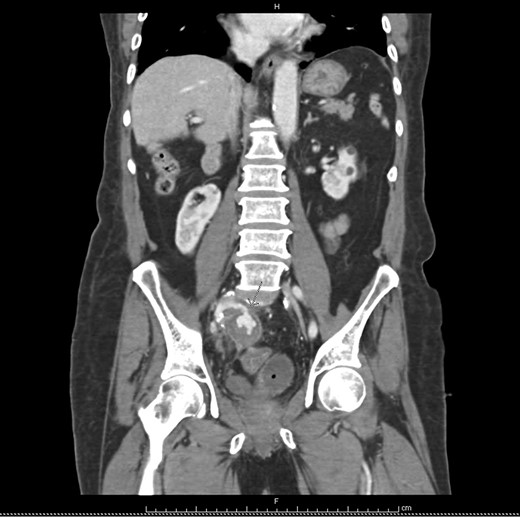 Coronal view iliac aneurysm.