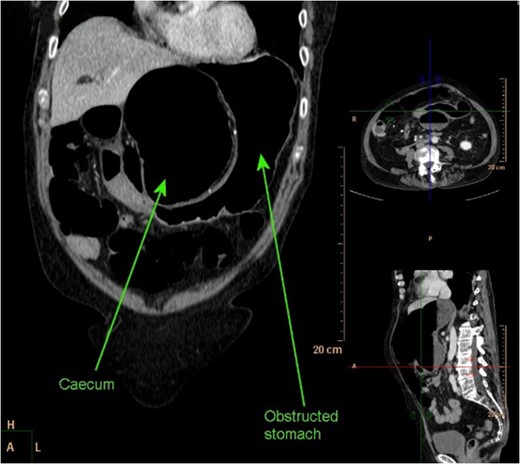CT abdomen coronal reconstruction demonstrating obstructed stomach with obstructed and dilated caecum present in lesser sac.