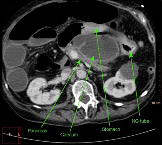 Axial section of CT abdomen demonstrating NG tube in stomach, with successful decompression of obstructed gastric outlet, however obstructed caecum clearly visible within lesser sac.