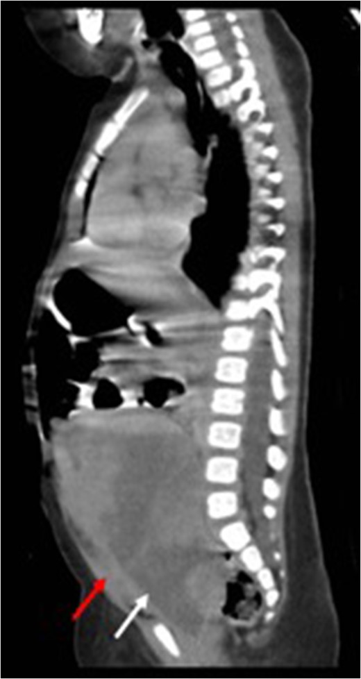 Before treatment sagittal view (CT) showing a large mass (white arrow) compressing on bladder (red arrow).