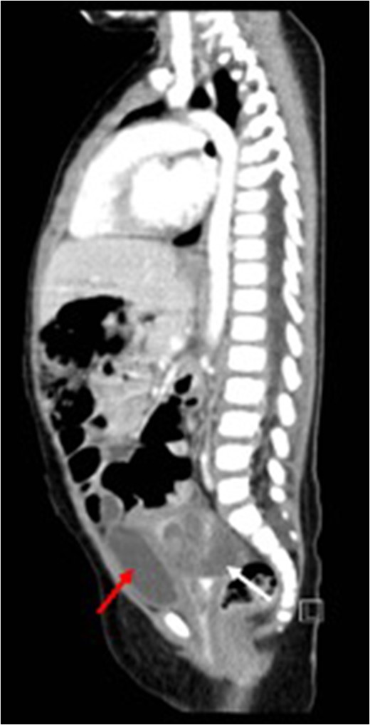 Sagittal view (CT) for the mass (white arrow) post-chemotherapy showing reduction in size (red arrow) bladder.