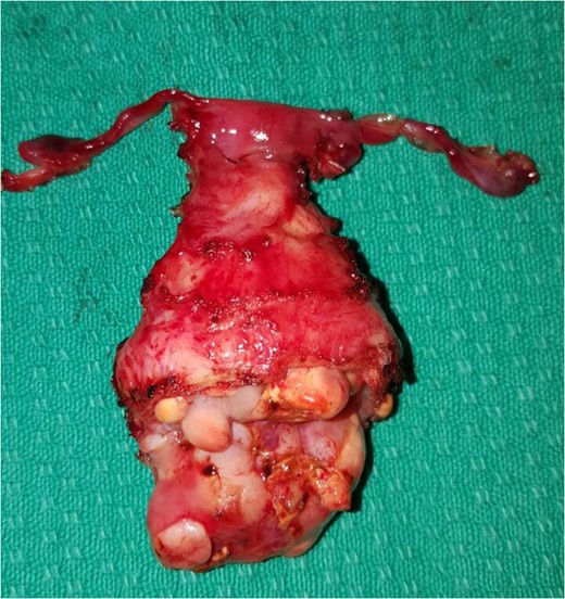 Total abdominal hysterectomy, bilateral salpingectomy with upper vaginectomy.