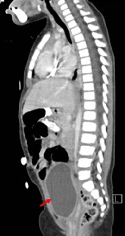 Post-treatment sagittal view (CT) with no evidence of recurrence arising from the uterus (red arrow) bladder.