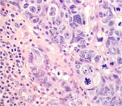 LCNEC in the external iliac lymph node. Nuclei are several times the diameter of lymphocytes (lower left), nucleoli are prominent, and chromatin quite coarse. Some nuclear moulding is seen, as in the small cell variant.