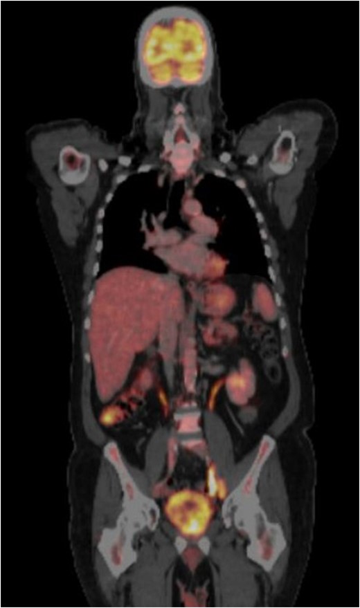 CT-PET performed after surgery showing metastatic disease with local recurrence of the mass extending into the cystectomy bed.