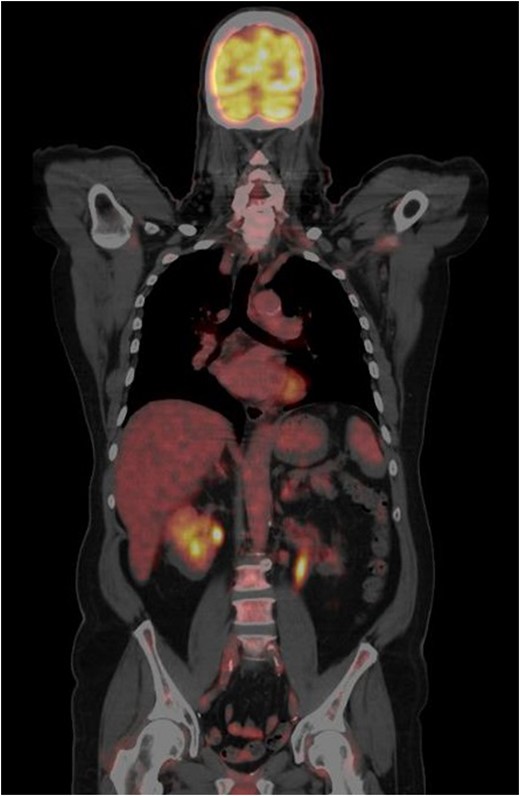 CT-PET done one year from the previous CT-PET. This showed complete remission of disease. No evidence of distant metastatic disease.
